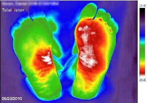 infrarot-medizinische-thermografie-entzuendungen