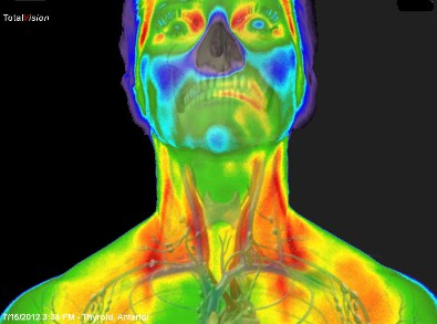 infrarot-medizinische-thermografie-thyroid