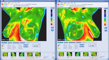 infrarot-medizinische-thermografie